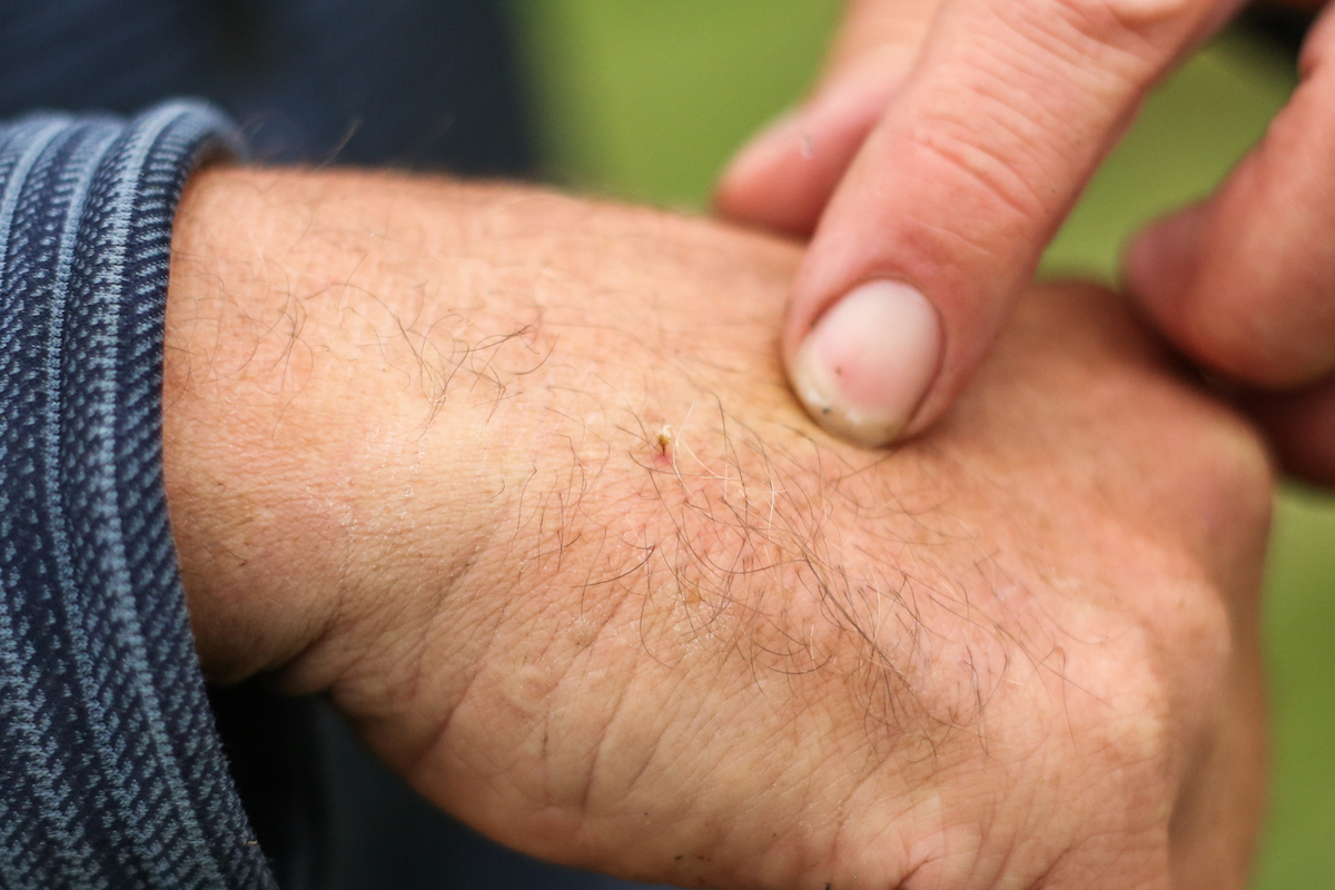 A close-up of a bee stinger stuck into the surface of a man&rsquo;s skin.
