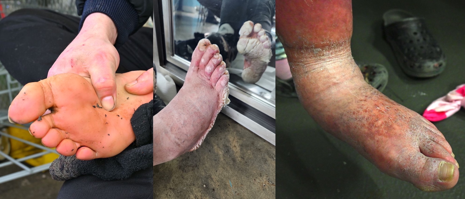Left: a man rubs the sole of his foot. Middle: a man with water-soaked, white, wrinkled feet. Right: a woman&rsquo;s foot has cellulitis.
