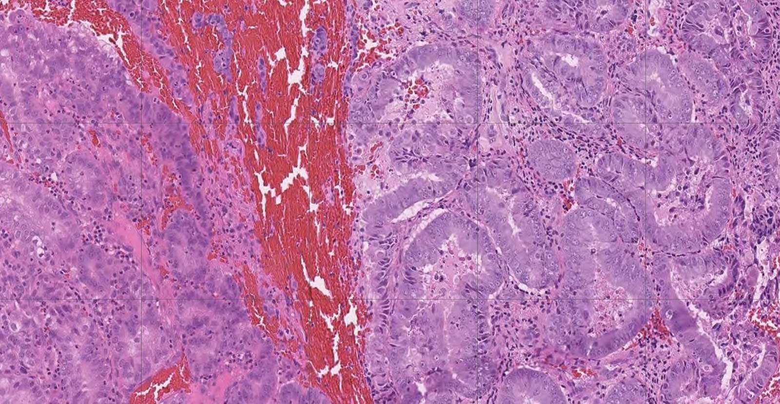 A scanned image of a tissue sample of endometrial cancer as it would appear under a microscope. Cells have been stained pink, purple and red and seem to form swirls and rivers.