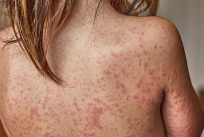 BC’s Largest Pocket of Measles Cases Likely Peaking, Officials Say